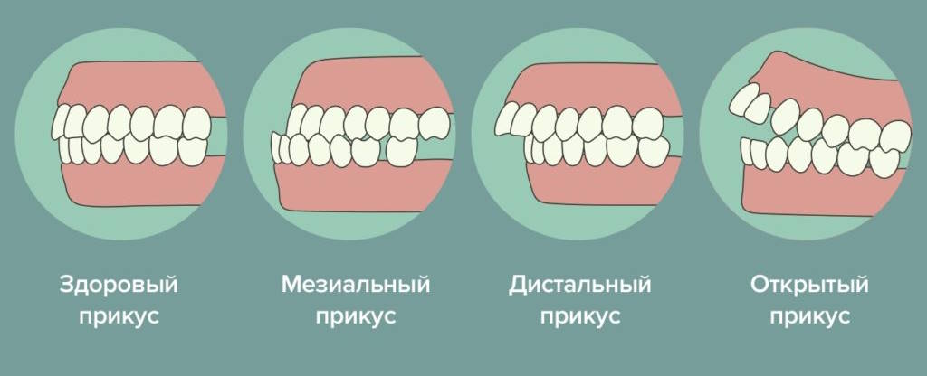 Металлические брекеты: как устроена система и каким образом она исправляет прикус