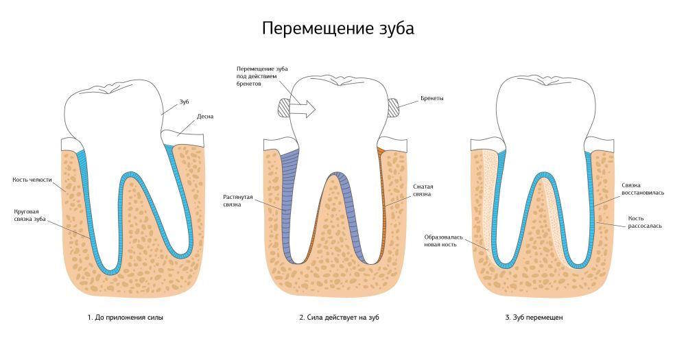 Металлические брекеты: как устроена система и каким образом она исправляет прикус